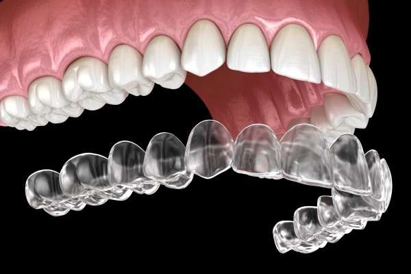 What Are Invisalign Clear Aligners?